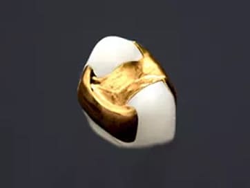 ゴールドインレー(小臼歯)